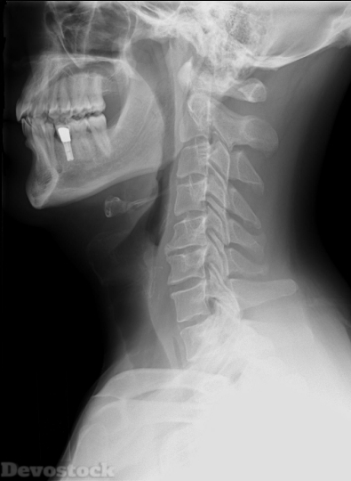 Devostock X-RAY PHOTO OF THE NECK BONE SEEN FROM THE SIDE