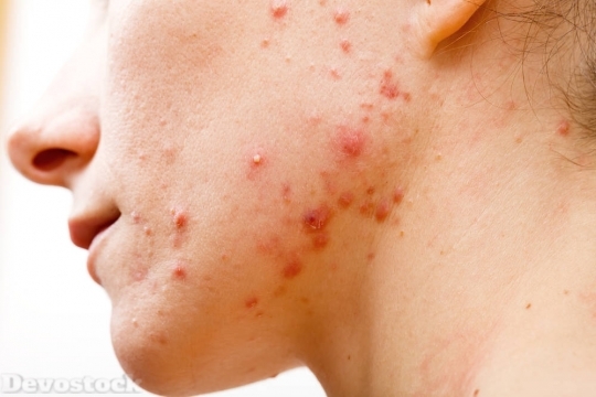 Devostock Skin Allergy  (22)
