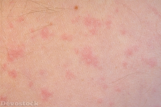 Devostock Skin Allergy  (5)