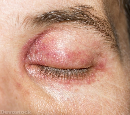 Devostock Skin Allergy  (7)
